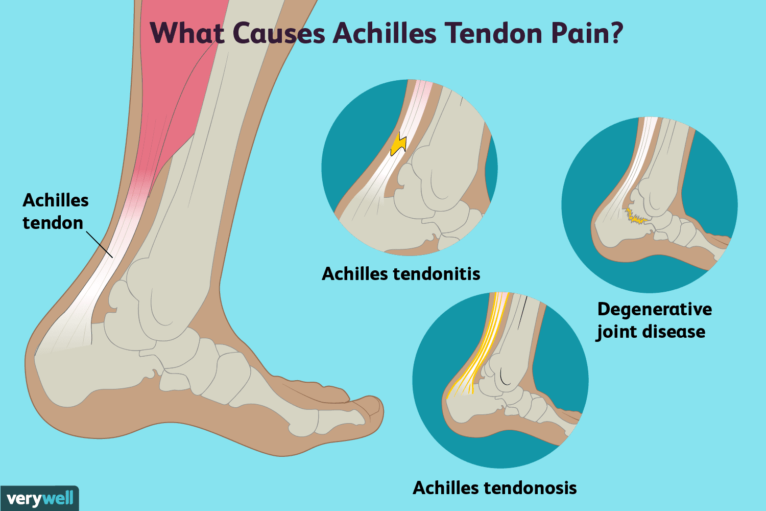 Achilles 2025 ankle pain