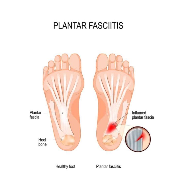 Plantarfasciitisvshealthyfootillustration The Pain Relief
